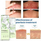 Eczemaron for Ringworm, Itching, Eczema & Fungal Infection Antifungal Cream (Pack of 2)