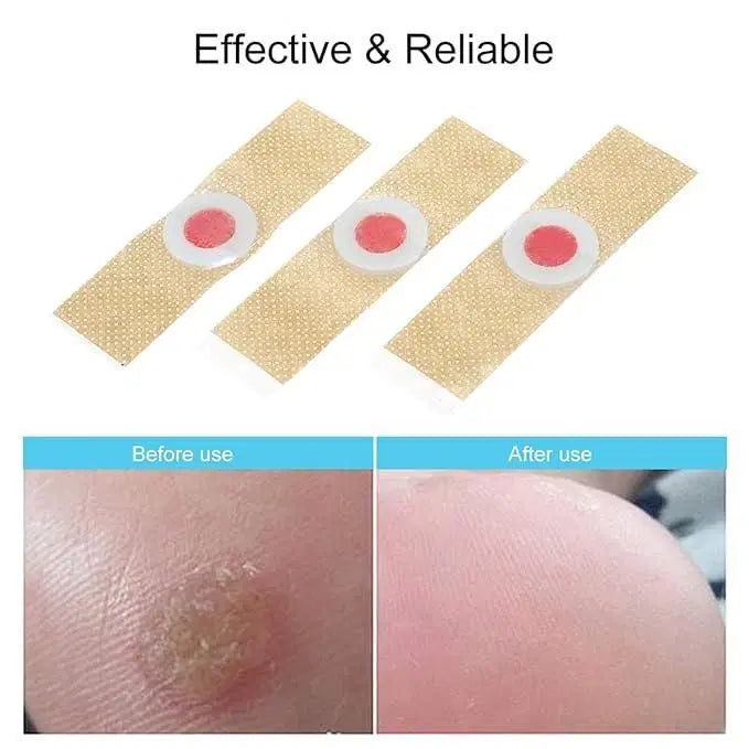 Corn Remover Pads Pack Of 12 - Foot Corn Callus Treatment