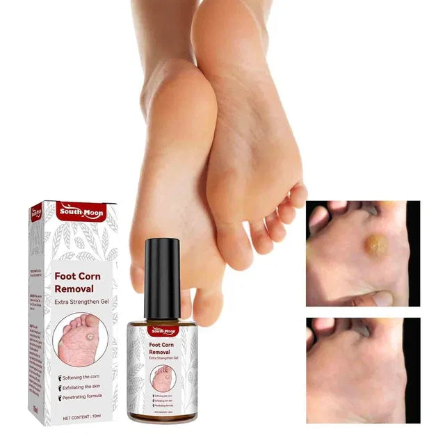 Feet Corn Removal Serum 30ml Pack Of 1
