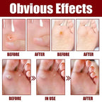 Feet Corn Removal Serum 30ml Pack Of 1