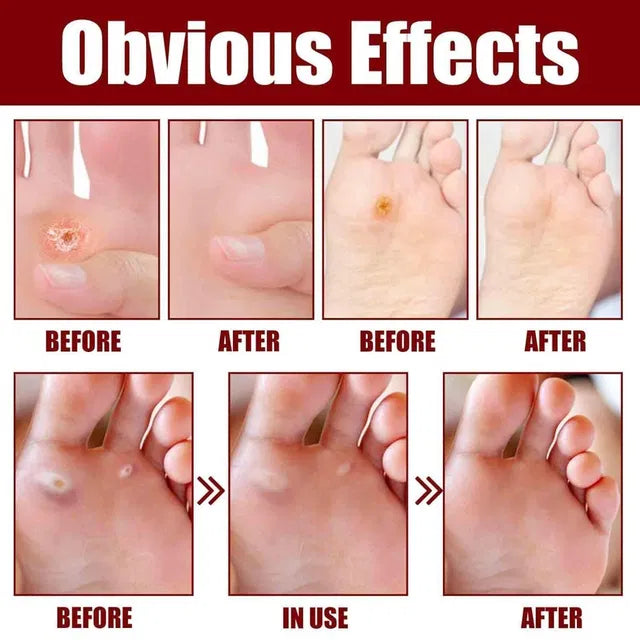 Feet Corn Removal Serum 30ml Pack Of 1