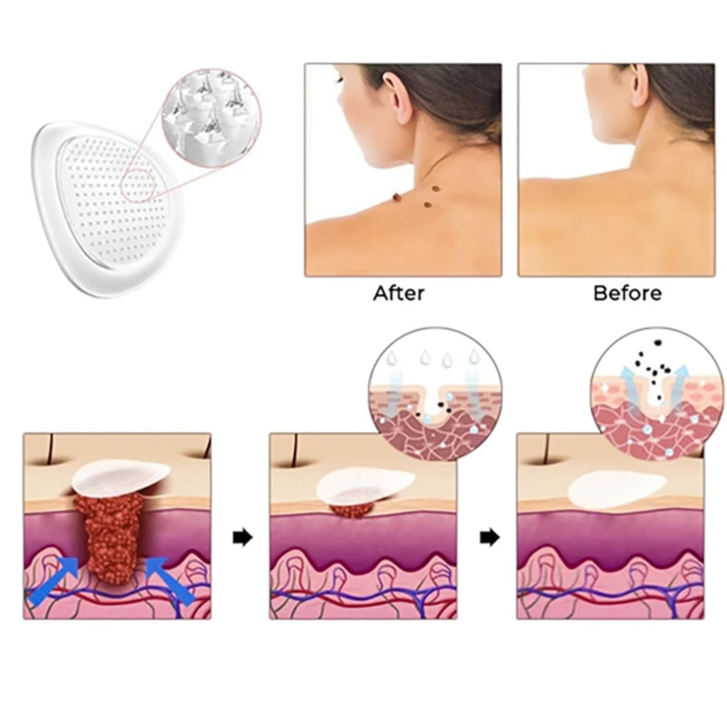 Skin Tag & Pimple Blemish Patch